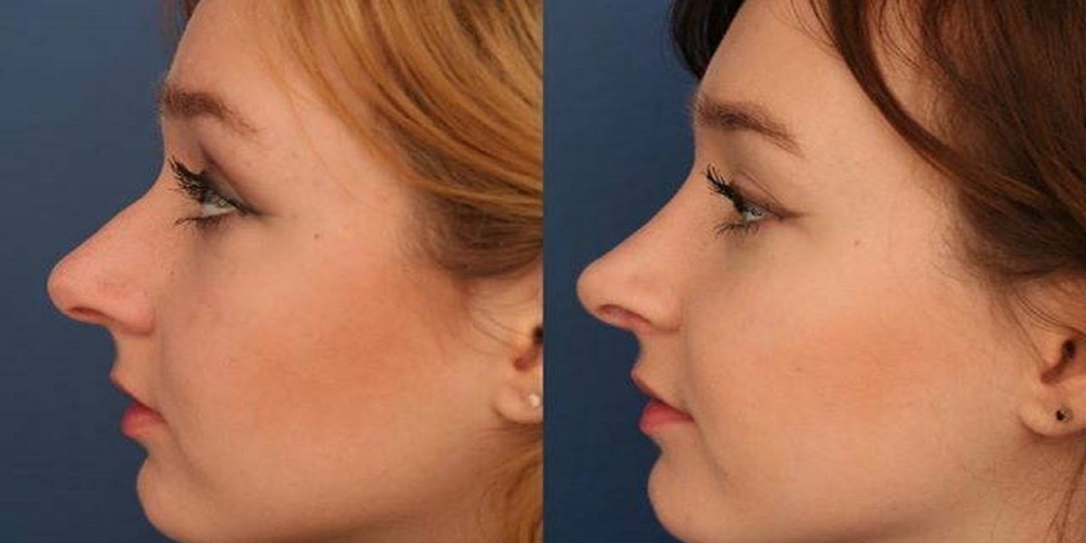 Rhinoplasty in Riyadh – Transforming Your Look with Expert Nose Surgery
