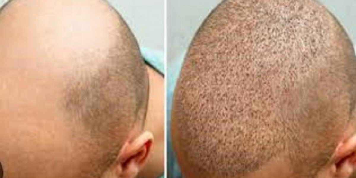 ? أحدث تقنيات زراعة الشعر في الرياض: ثورة في استعادة الكثافة والشباب