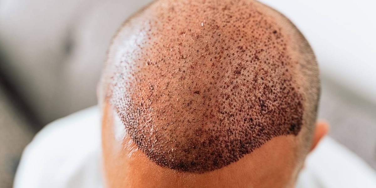 Why Turkey Has Become a Leading Destination for Hair Transplants