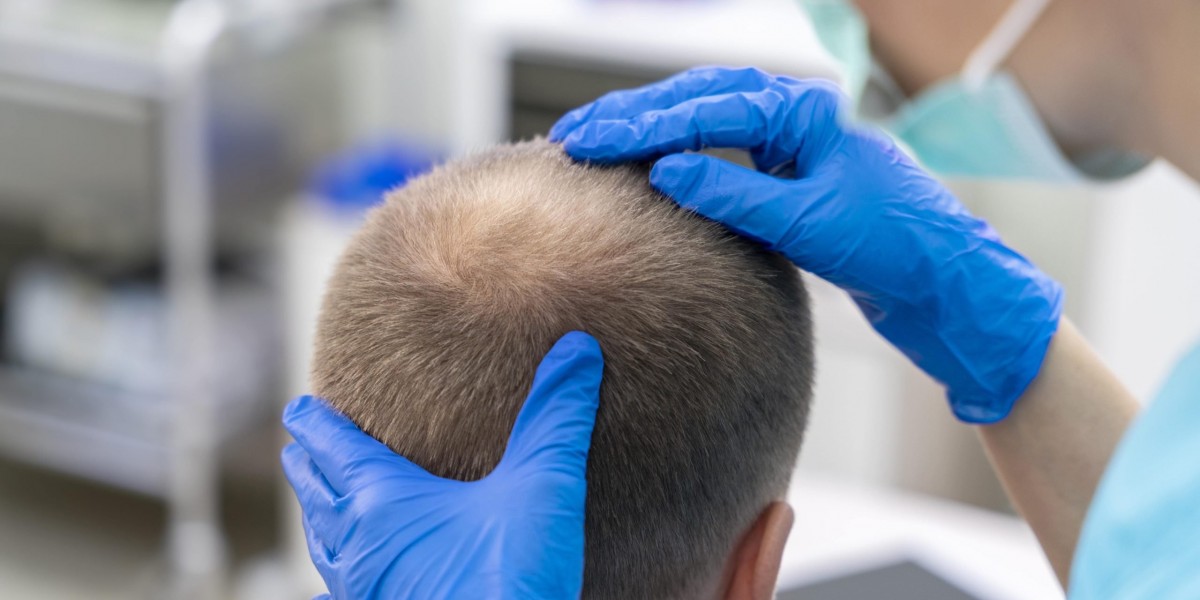 هل عملية زراعة الشعر في الرياض مؤلمة؟ إليك التفاصيل