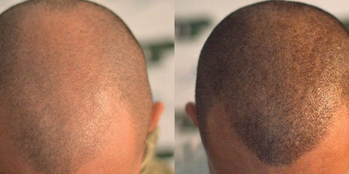 Scalp Micropigmentation in Islamabad for Men Facing Pattern Baldness
