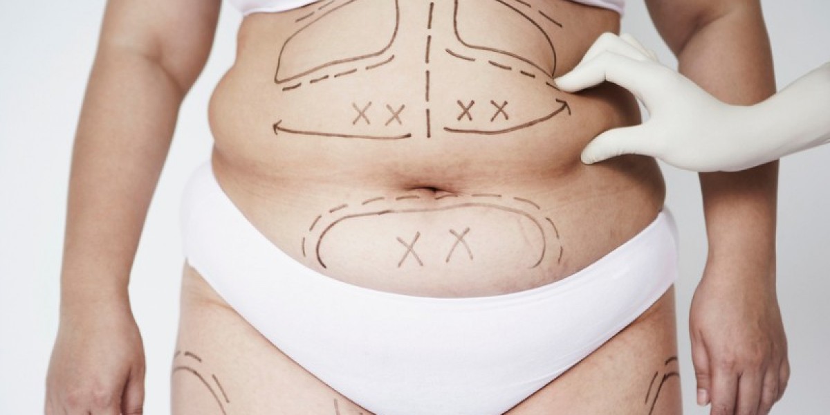 What Areas Can Be Treated With Liposuction Surgery?