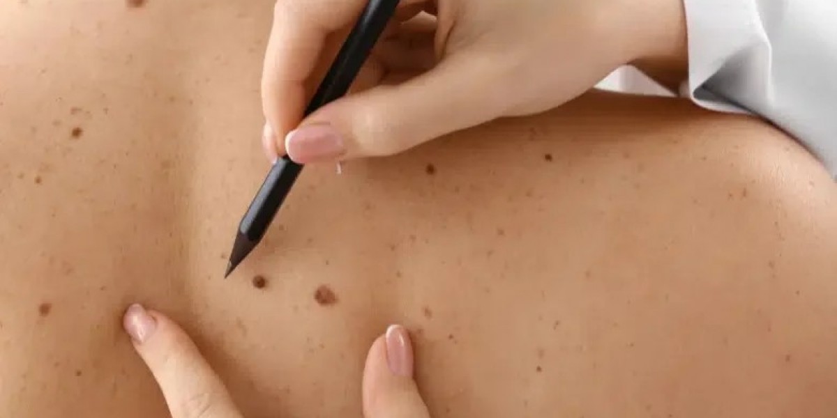 Mole Removal In Dubai: Risks, Benefits & Safety Tips