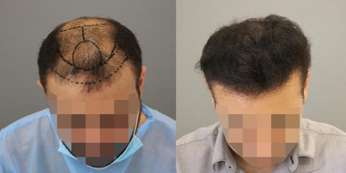 Affordable Hair Transplant in Abu Dhabi: Costs, Options, and Results