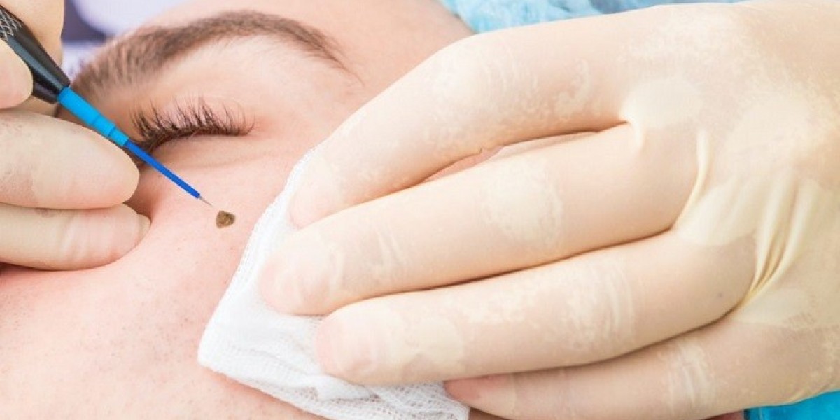 Mole Removal In Dubai: How to Choose the Right Clinic