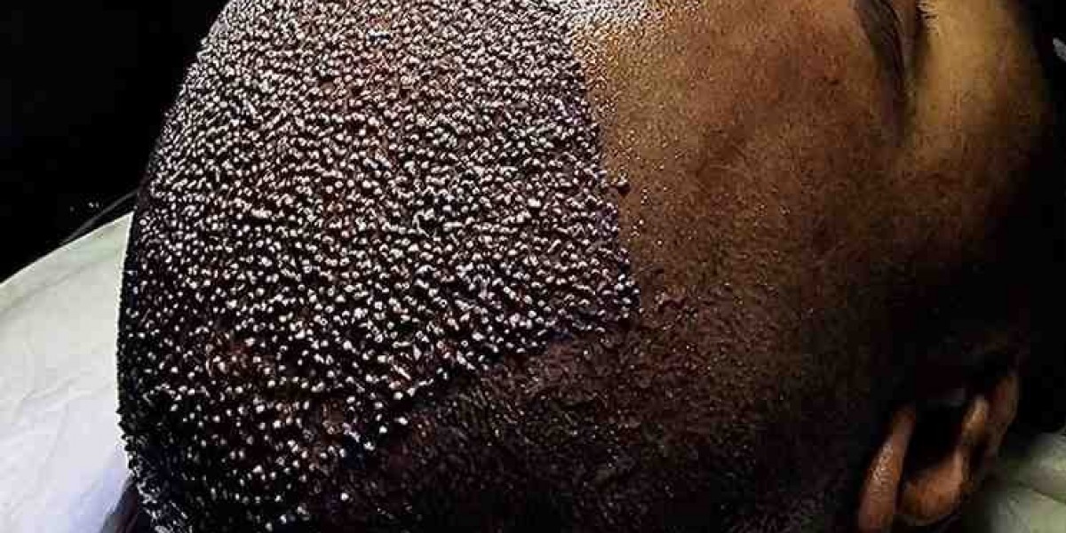 FUE Hair Transplant in Islamabad: What Doctors Recommend