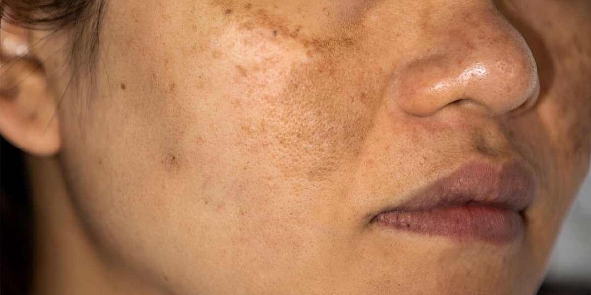Professional Hyperpigmentation Treatment Islamabad