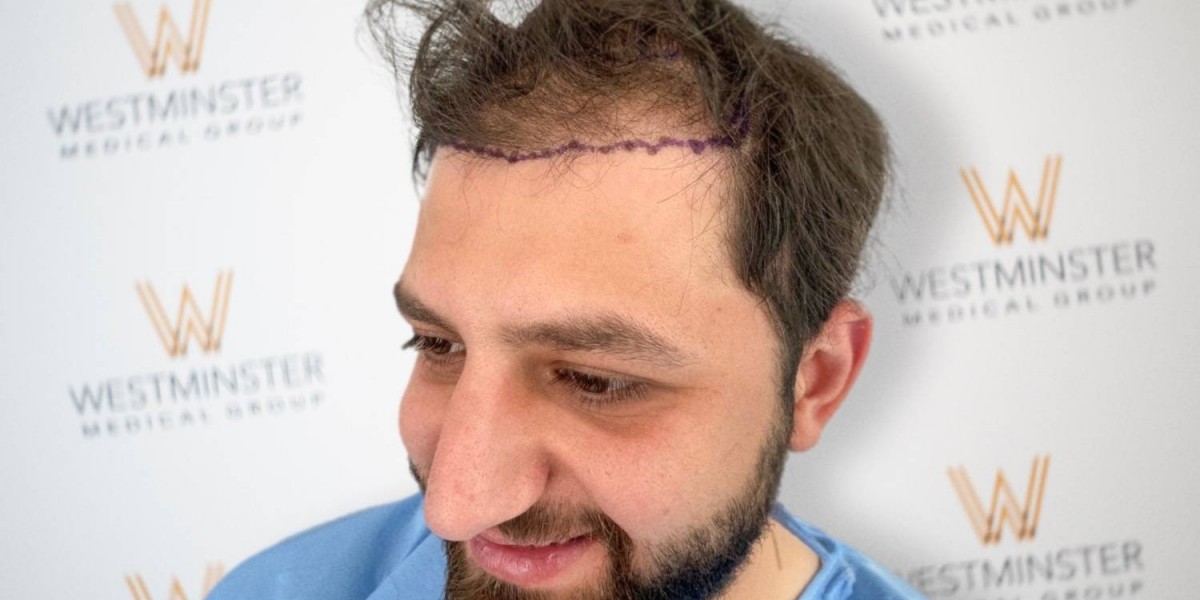 Top Reasons to Choose a Hair Transplant in the UK Today