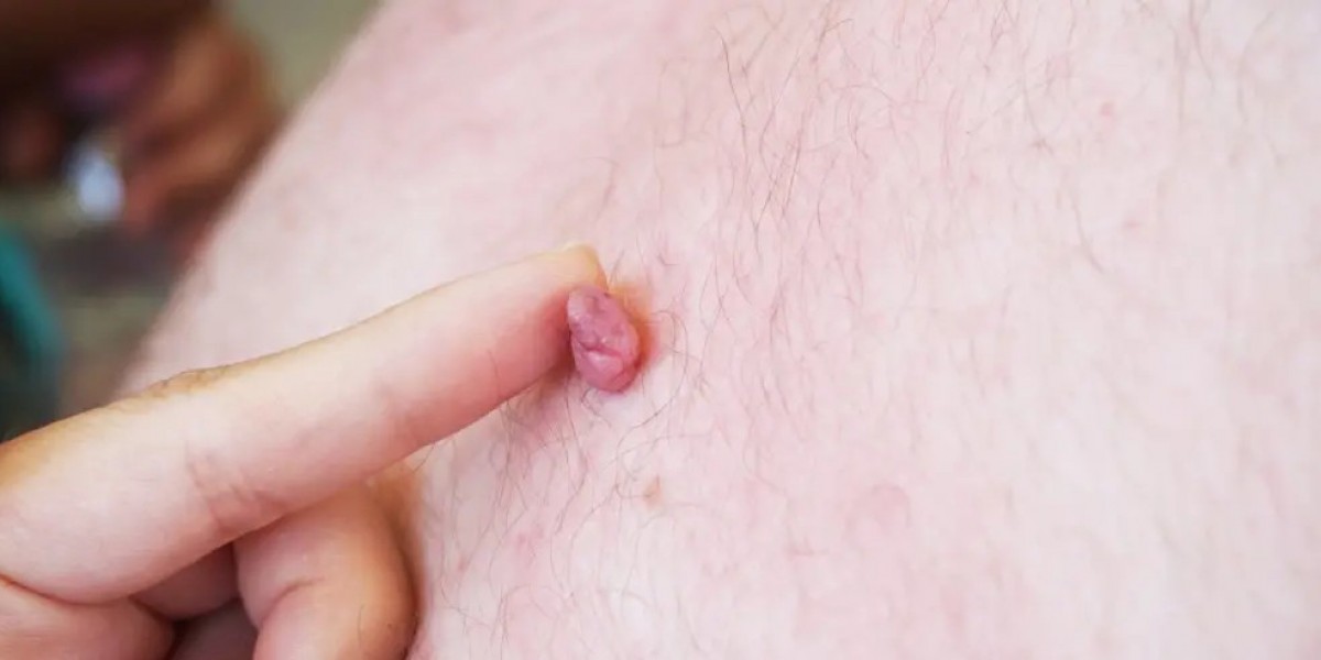 Skin Tag Removal: When to See a Dermatologist