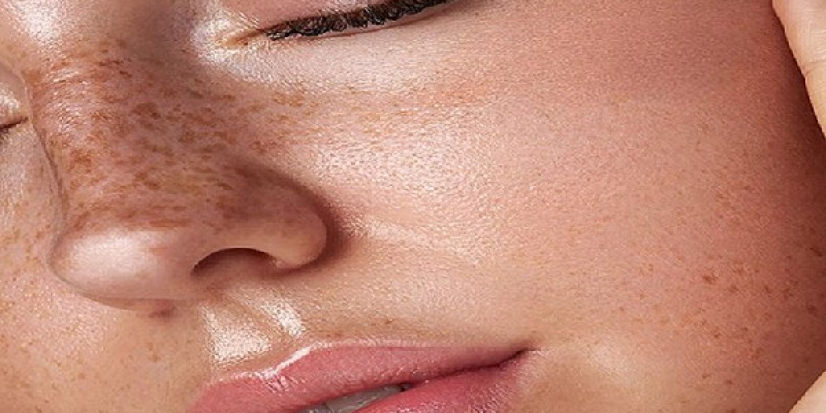 Say Goodbye to Dark Spots with Melasma Treatment in Islamabad