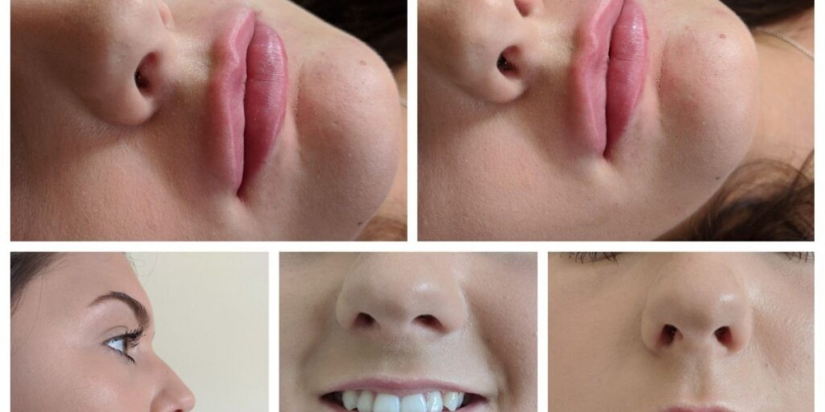 Lip Enlargement Service in the UK: Achieve Fuller, Natural-Looking Lips Safely