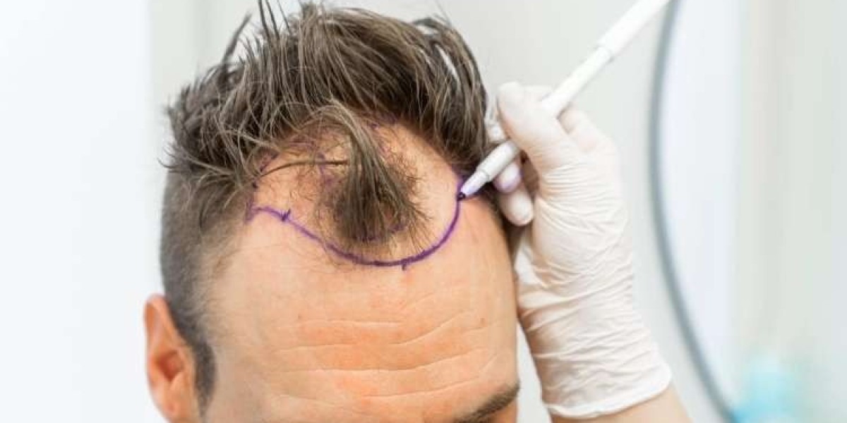 Hair Transplant in Islamabad for Men: Causes, Solutions, and Results