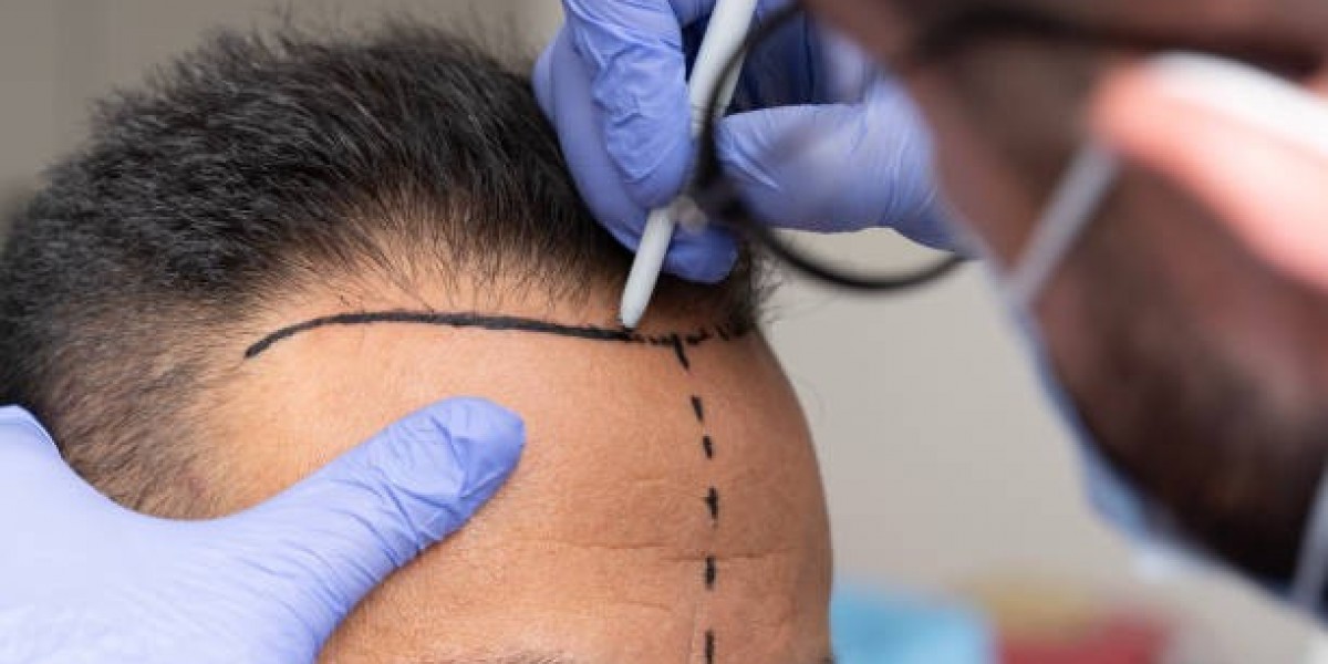 How Sun Protect New Grafts Post Hair Transplant?