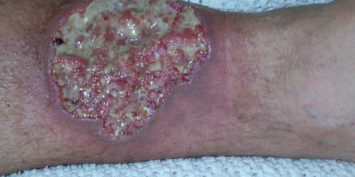 Effective Home Remedies for Pyoderma Treatment