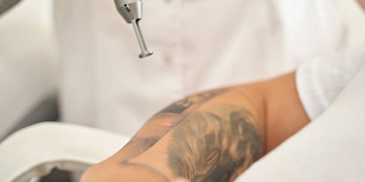 Laser Tattoo Removal: A Sustainable Solution for Body Art Reversal in Riyadh