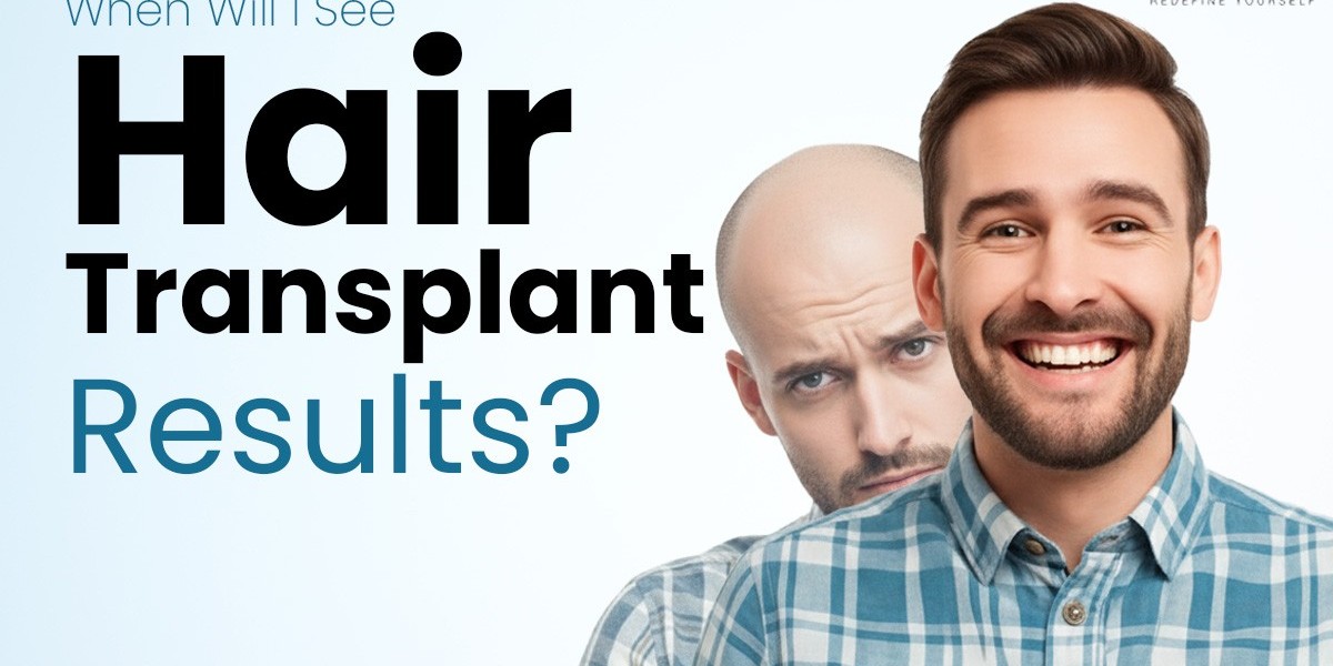 Change your appearance with High-end hair transplant in Delhi.
