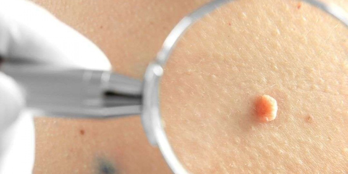 Moles Removal in Dubai for Clear Skin