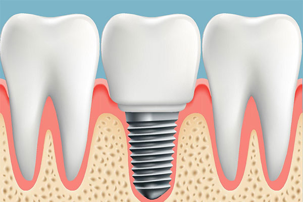 Dental Implants Canberra | Dental Implant Cost | Molonglo Dental Surgery