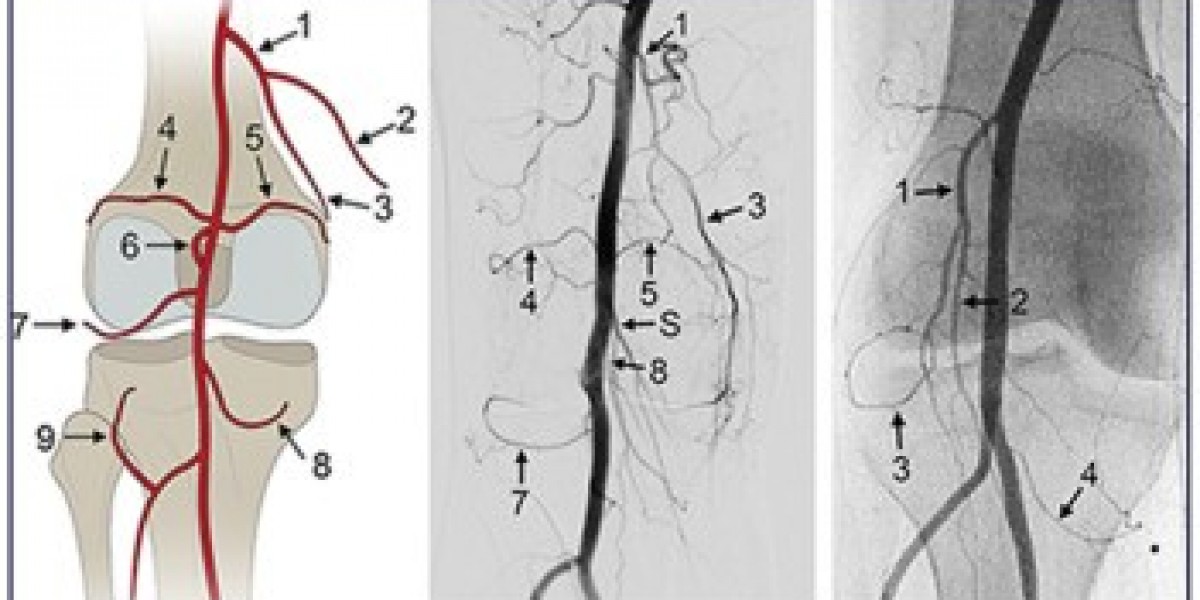 Genicular Nerve Block for Knee Pain &mdash; What It Is