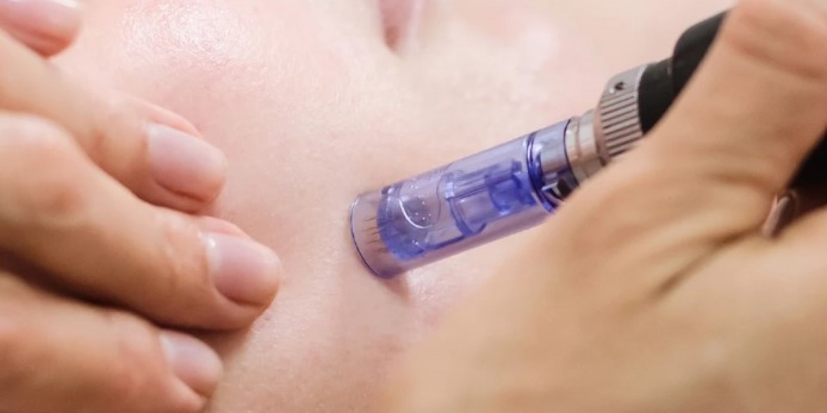 Microneedling in Manchester for Smooth, Clear Complexion