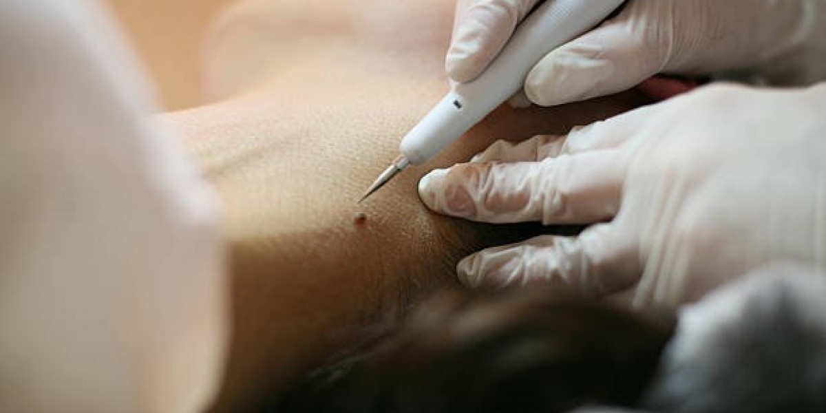 Understanding Melanocytic Nevi: When to Seek Mole Removal in Dubai