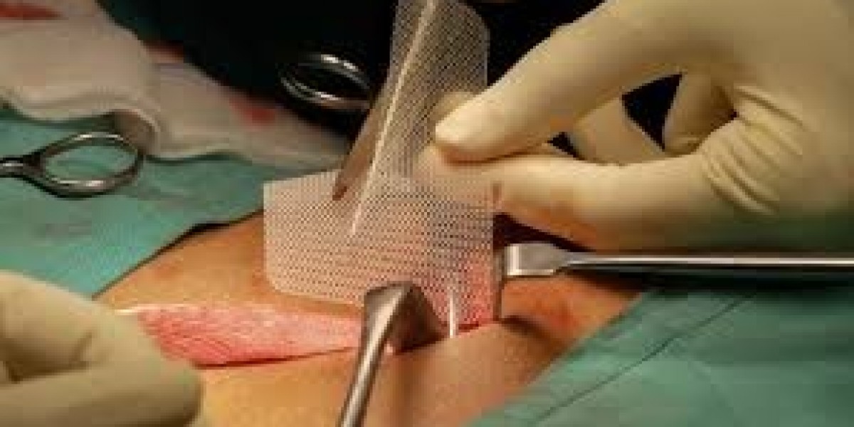 Hernia Surgery in the UK: Modern Treatment for a Healthier Life