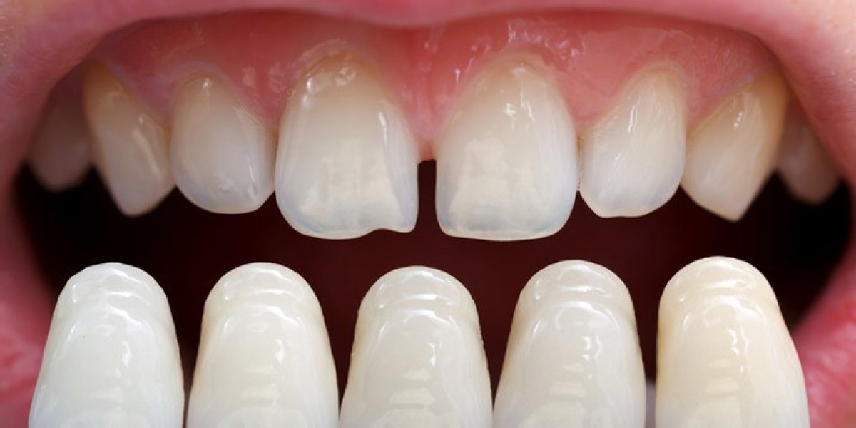 How Veneers Newport Beach Can Transform Your Confidence Instantly