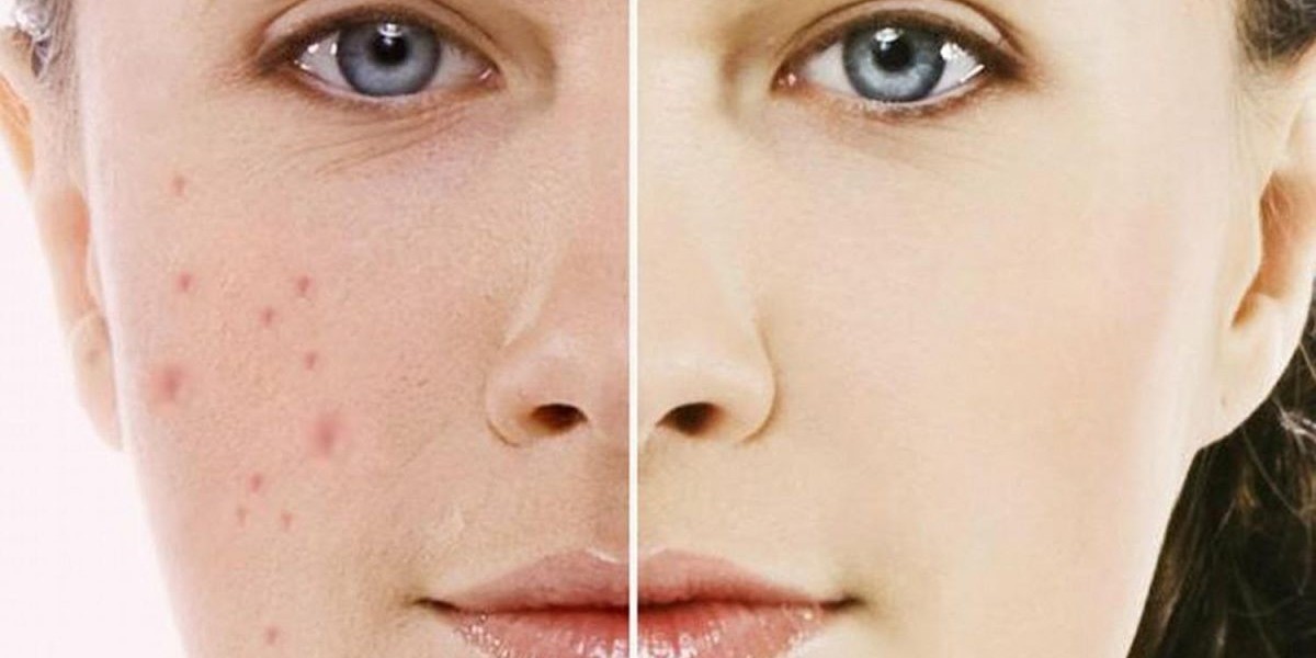 Pigmentation Laser Treatment Price & Pigmentation Removal Treatment