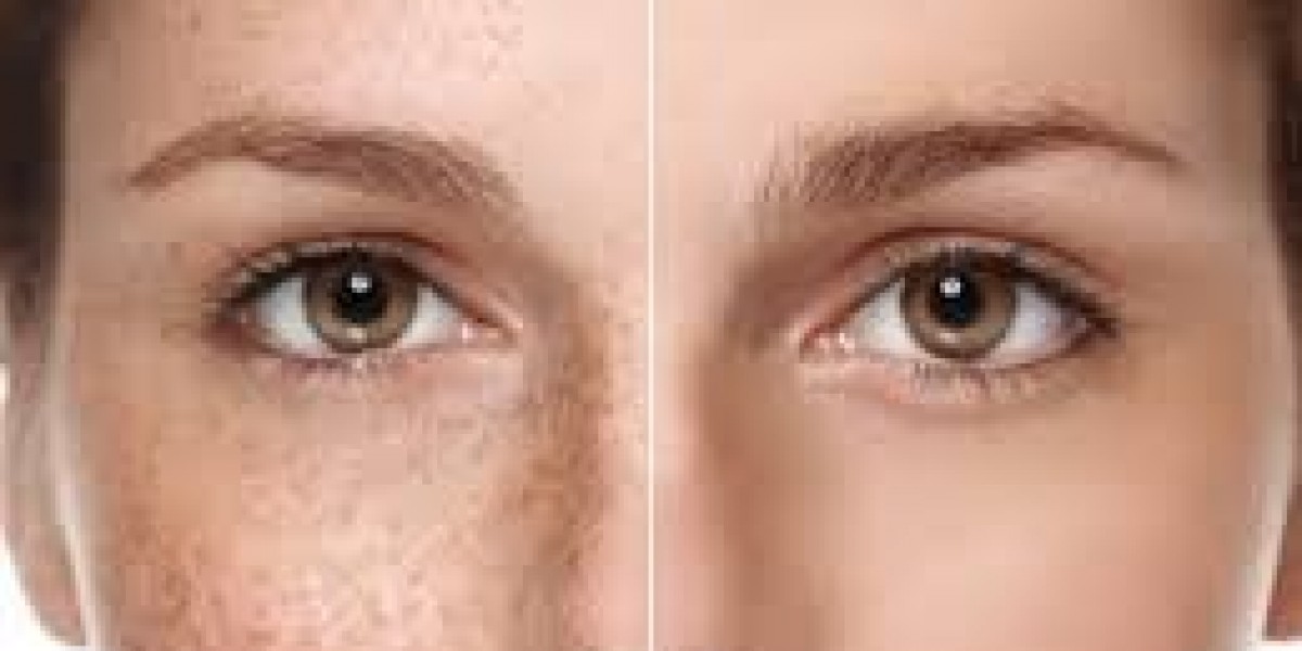 Best Treatment For Stretch Marks and Laser Birthmark Removal: Advanced Solutions for Healthier, Clearer Skin