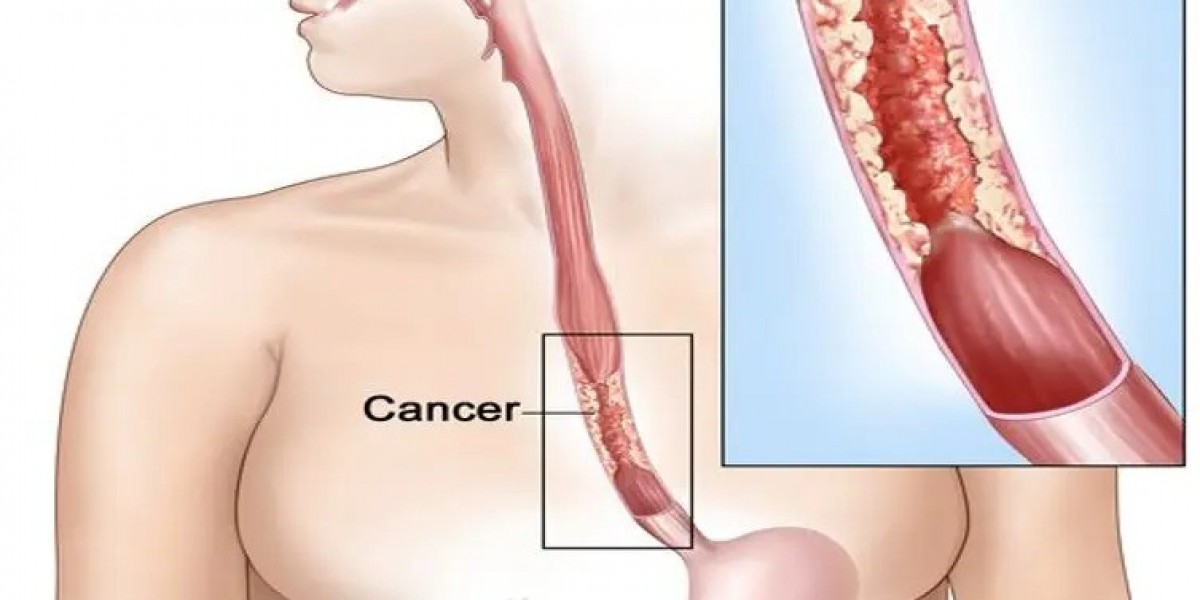 Esophageal Cancer Treatment in Delhi | Esophageal Cancer Treatment in India