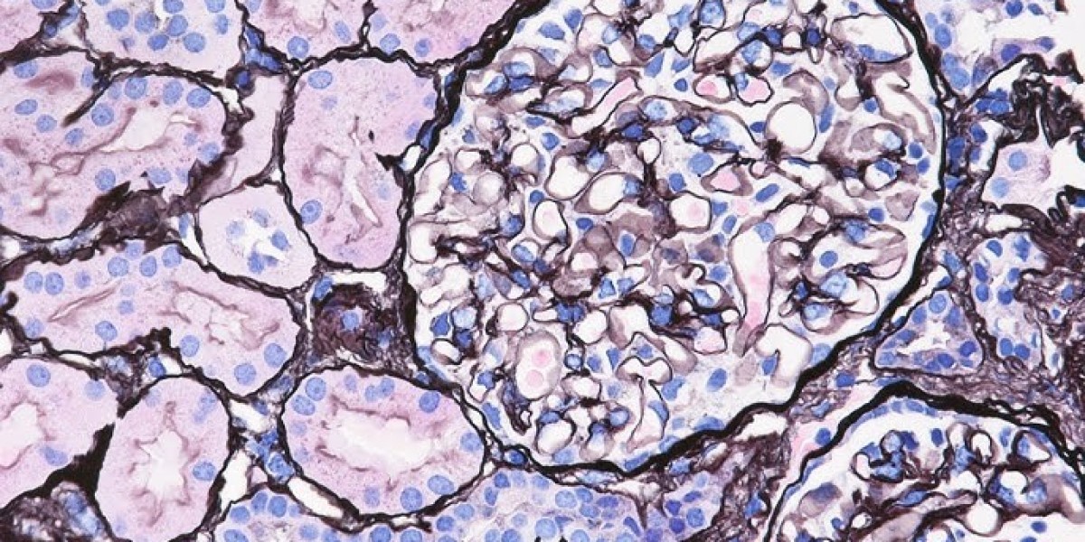 FSGS Symptoms & Treatment Guide for Kidney Health