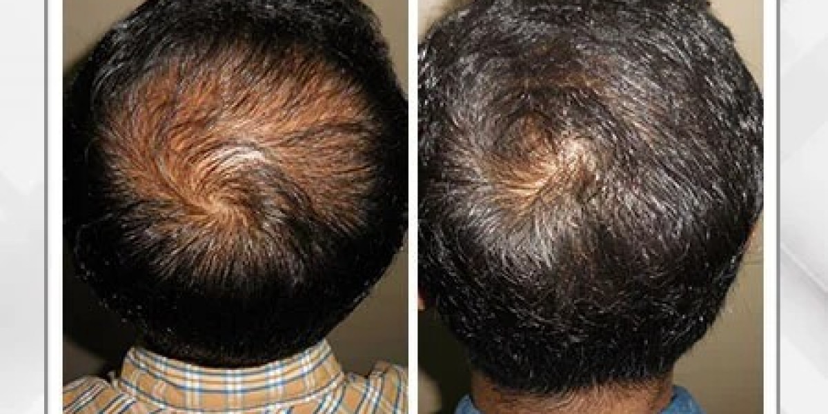 Hair Loss Treatment in Kolkata | Best Hair Transplant Clinic in Kolkata – Dr. Pauls Online
