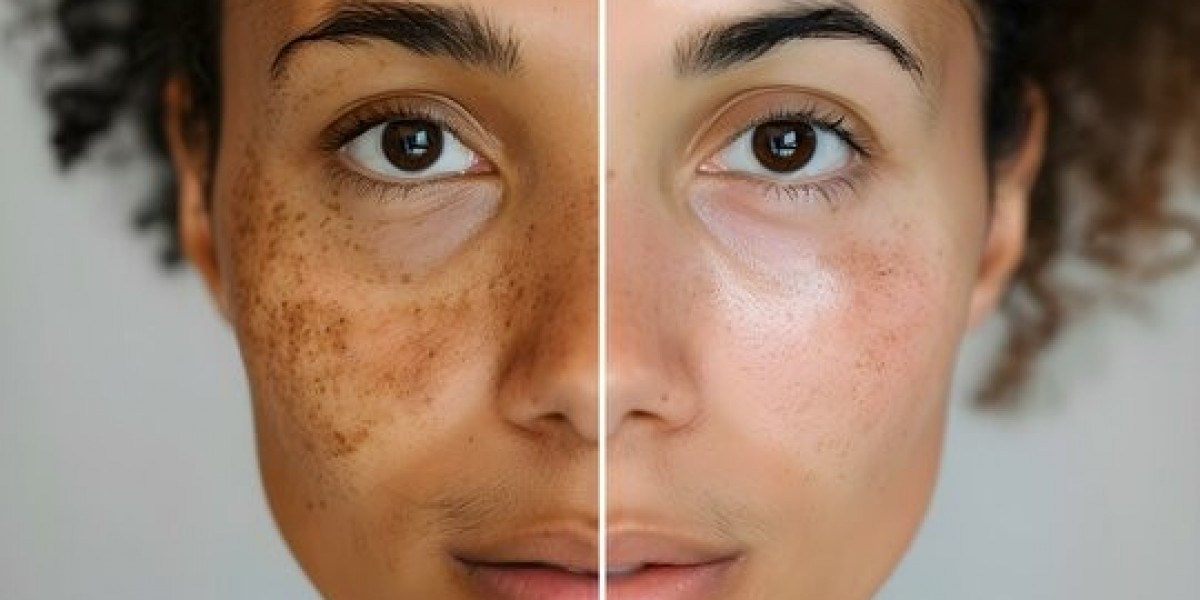 Skin Pigmentation in Dubai: Causes and Treatments