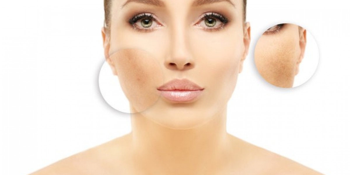 Skin Pigmentation in Dubai: Safe Treatment Options