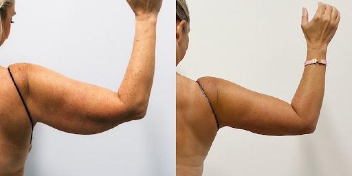 Arm Lift Surgery in Dubai for Sagging Arm Skin