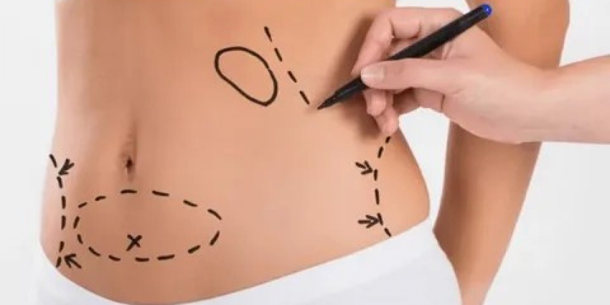 Tummy Tuck in Dubai: Personalized Care for Your Needs