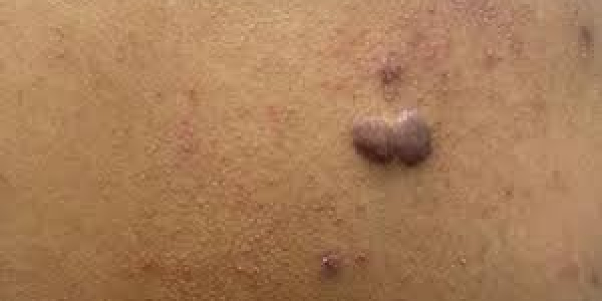 Keloid Skin Treatment: A Complete Guide to Understanding and Treating Keloid Scars