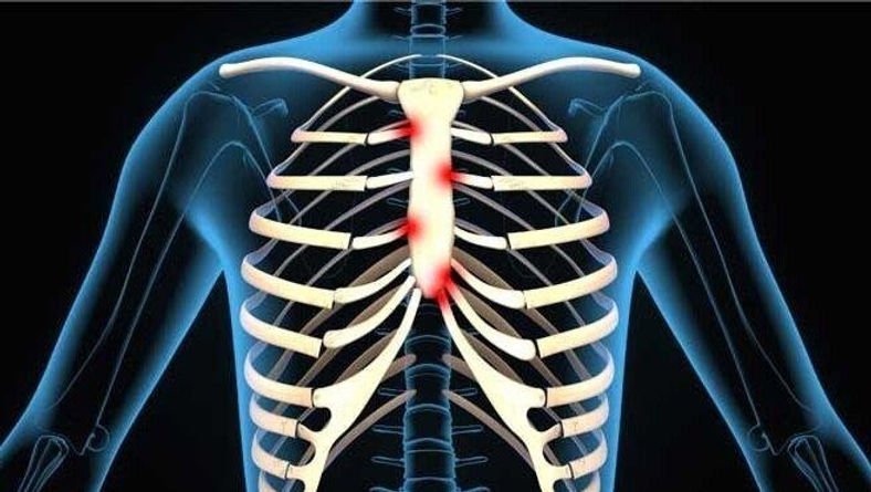 Best Costochondritis Treatment In Gurgaon