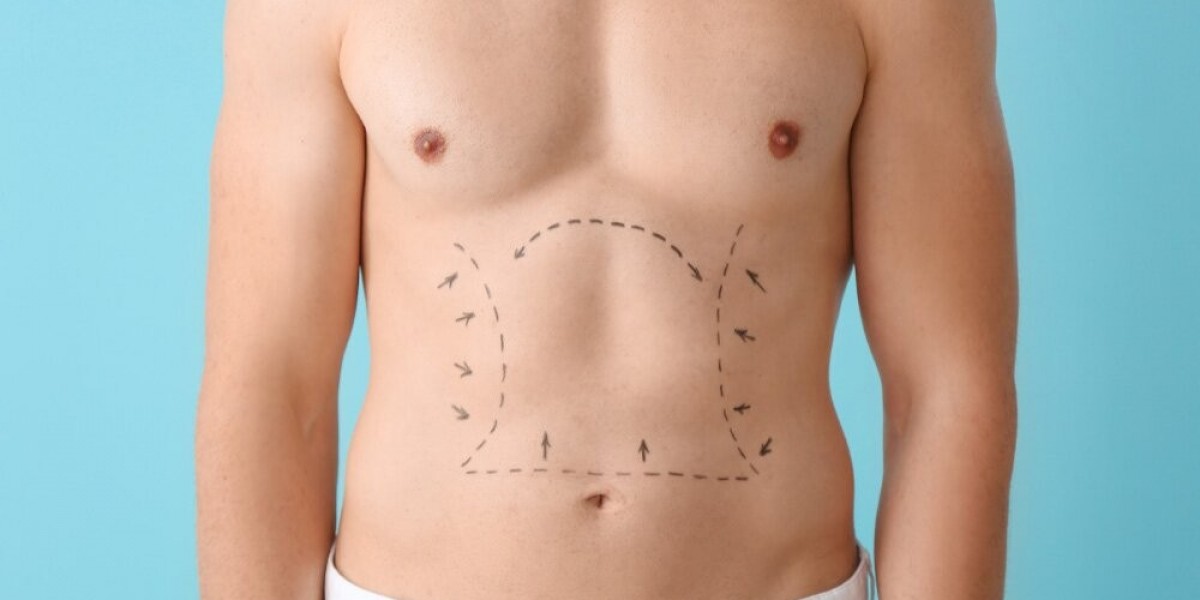 Things to Know Before Choosing Laser Liposuction Dubai