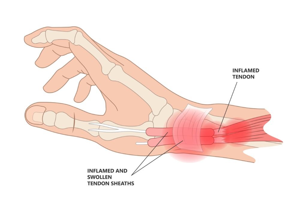 Best De Quervain Tenosynovitis Treatment In Gurgaon